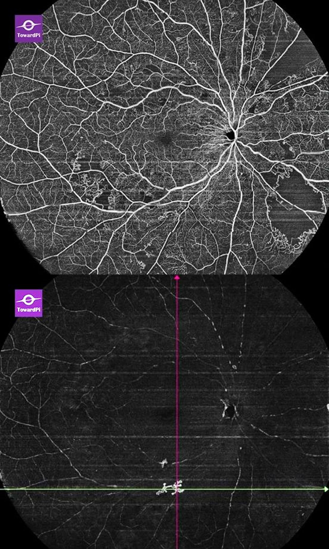 HD OCTA of 120°, Visualization of MA, NPA, IRMA, NVE, and everything. Top: retina slab, Bottom: vitreous slab.