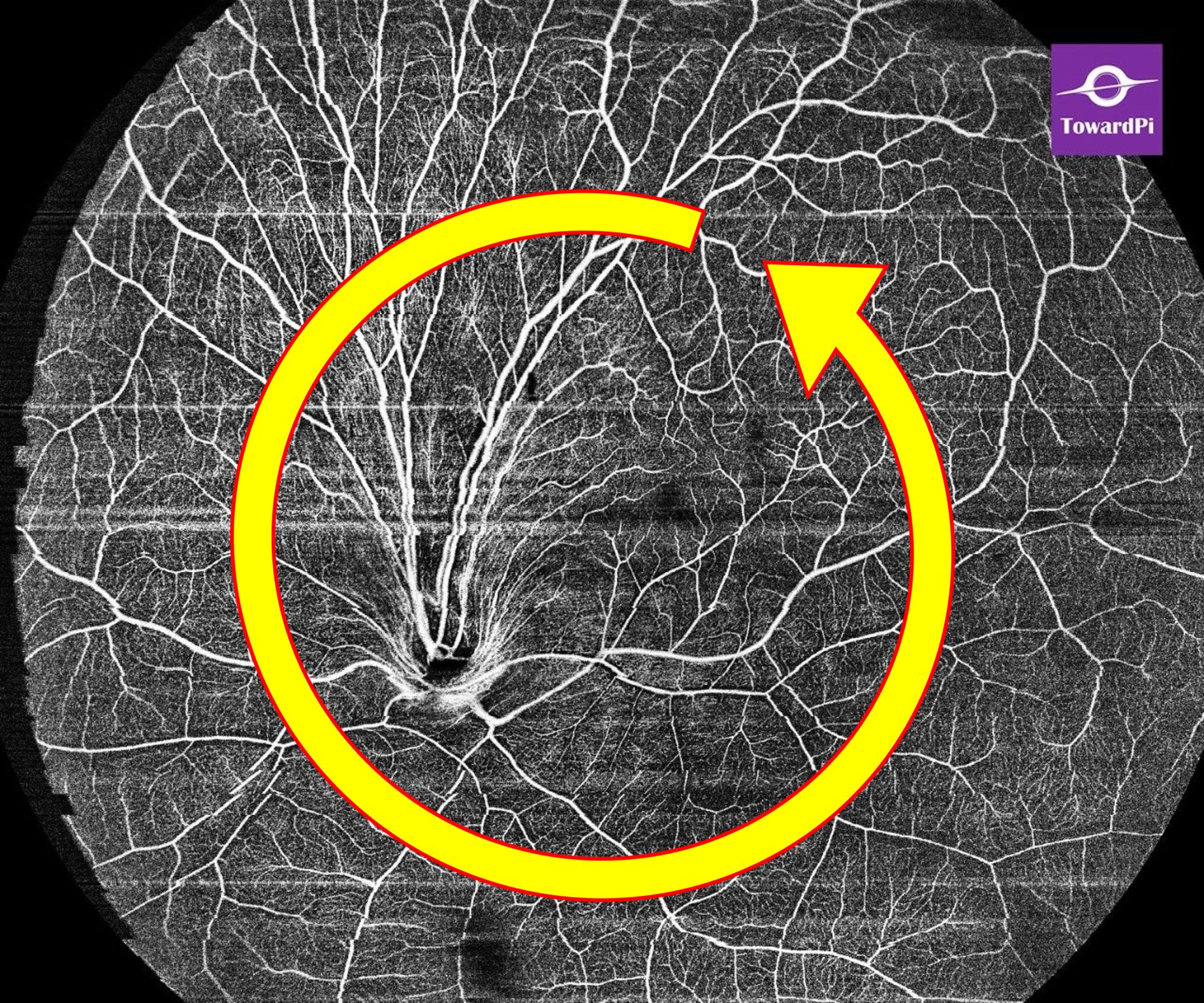 Congenital ectopic macula with optic disc rotation captured with OCTA technology