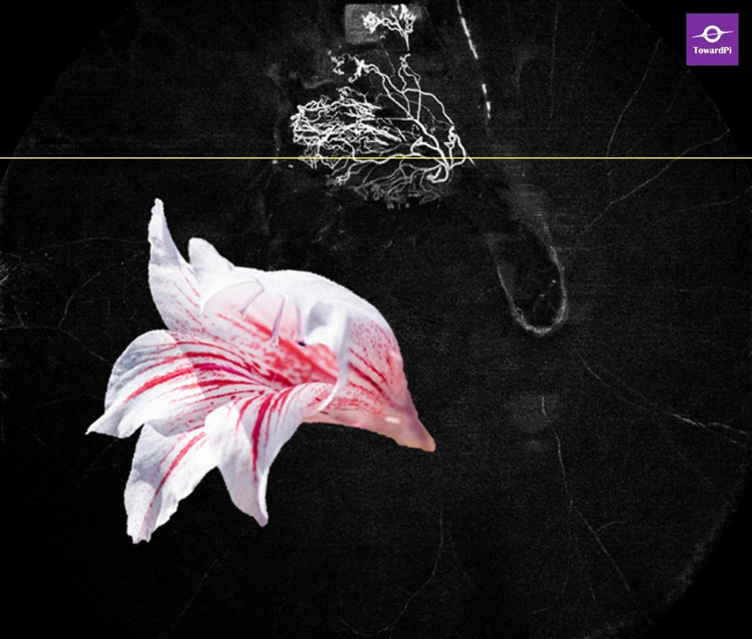 Switching to the segmentation of vitreous layer, neo vessels could be seen in details growing from occluded retinal vein to the vitreous, just like a bloom of gladiolus.