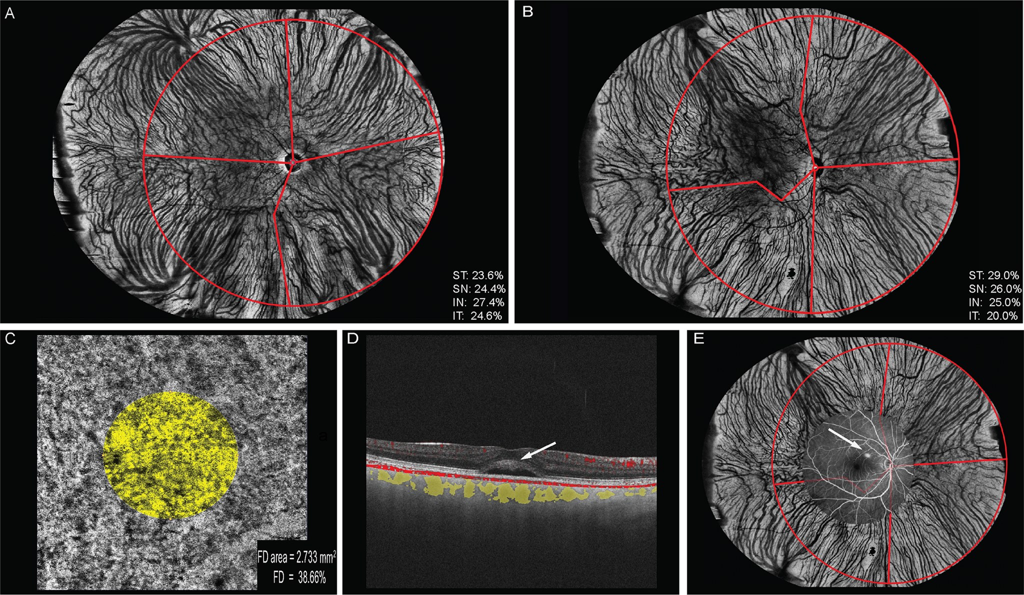 Fig1.  A-B showed the different VV% between healthy eye and CSC eye. The macular leakage rate was significantly higher in the ST quadrant after colocating the leakage points in FA with the En Face OCT as shown in figure E. 