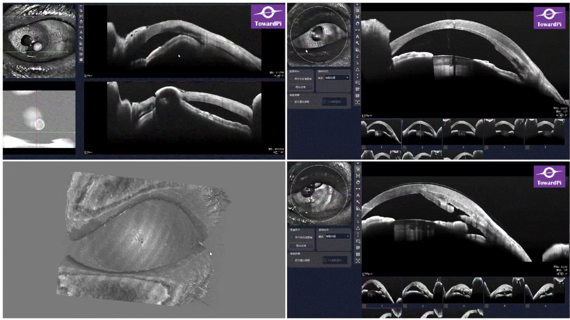 Corneal ulcer perforation SS-OCT, before and after double lamellar keratoplasty.